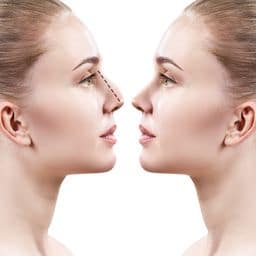 Before and after of a rhinoplasty