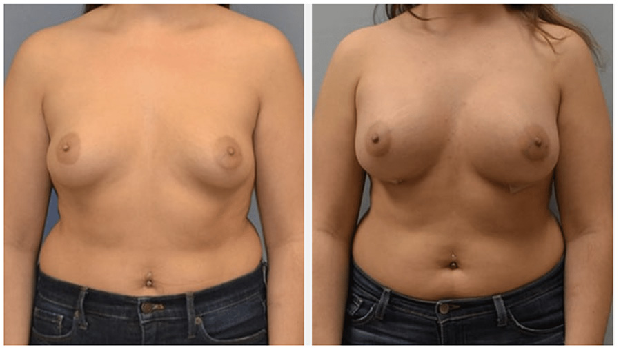 Breast Augmentation Actual Patient 2