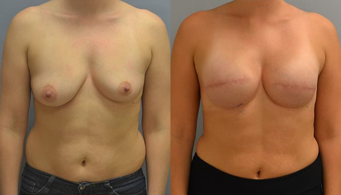 Breast Reconstruction Patient 2