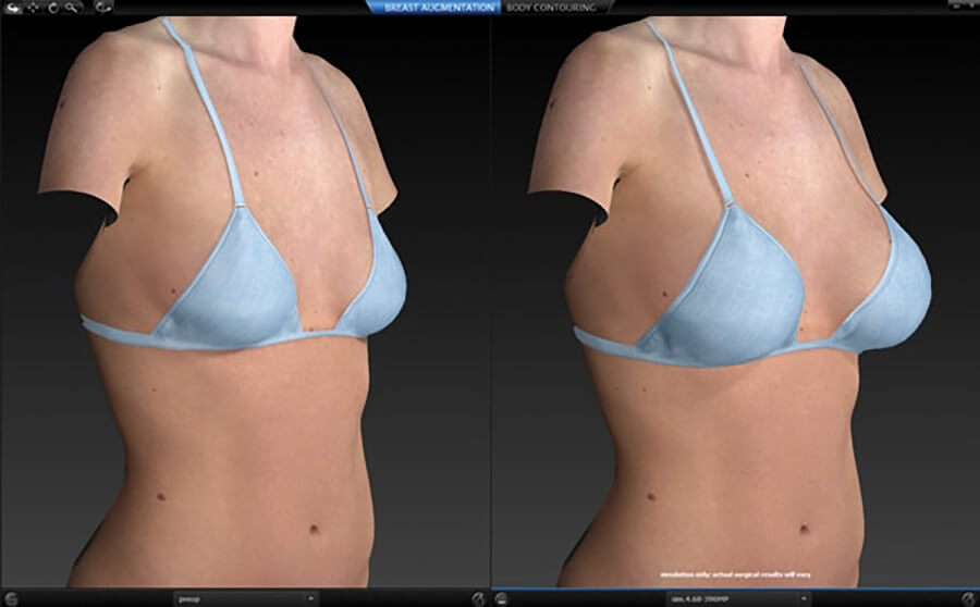 3d animation of before and after breast augmentation