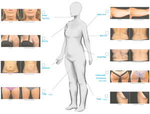 Coolsculpting procedure region