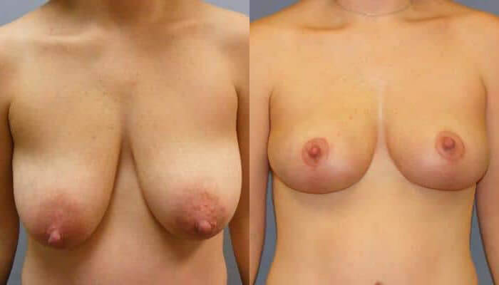 Breast Lift Patient 2