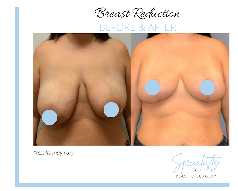 Before and after image showing the results of a breast reduction performed in Raleigh, NC.