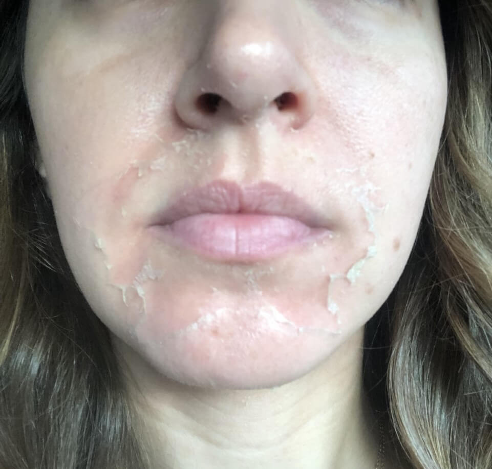 Image of a woman's skin peeling after a chemical peel.