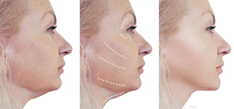 A woman before and after cosmetic facial surgery.