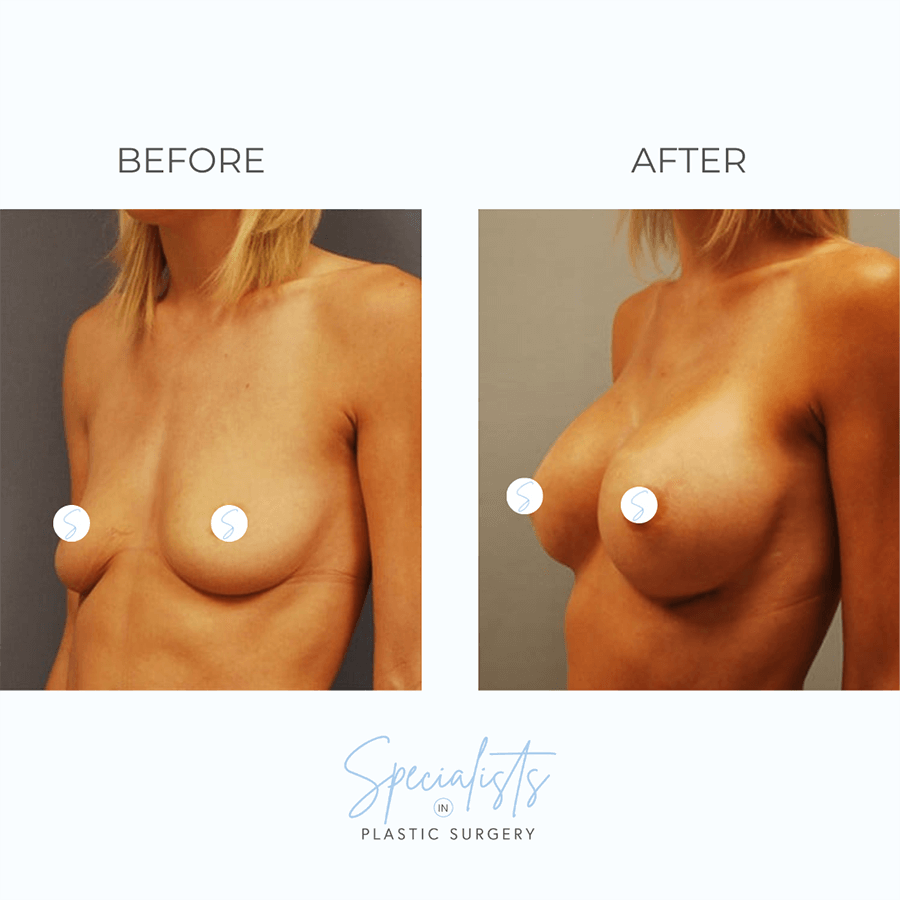 Actual Patient Results - Breast Augmention
