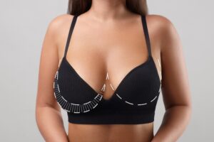 A woman wearing a black surgical bra with white dotted measurement lines, indicating surgical planning for a breast reduction procedure.