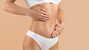 inimize marks after surgery. Discover how silicone sheets and lasers help liposuction scars fade at our Raleigh plastic surgery practice.