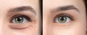 Before and after comparison of crow's feet wrinkles around the eye area showing visible reduction of lateral canthal lines following botulinum toxin injection treatment