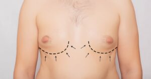 Surgeon marking male chest with dotted lines before gynecomastia reduction surgery