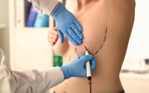 A medical professional in blue gloves using a black marker to draw surgical guidelines on a patient's breast in preparation for a breast reduction procedure.