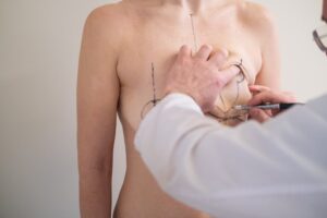 plastic surgeon marking patient breast before reduction surgery