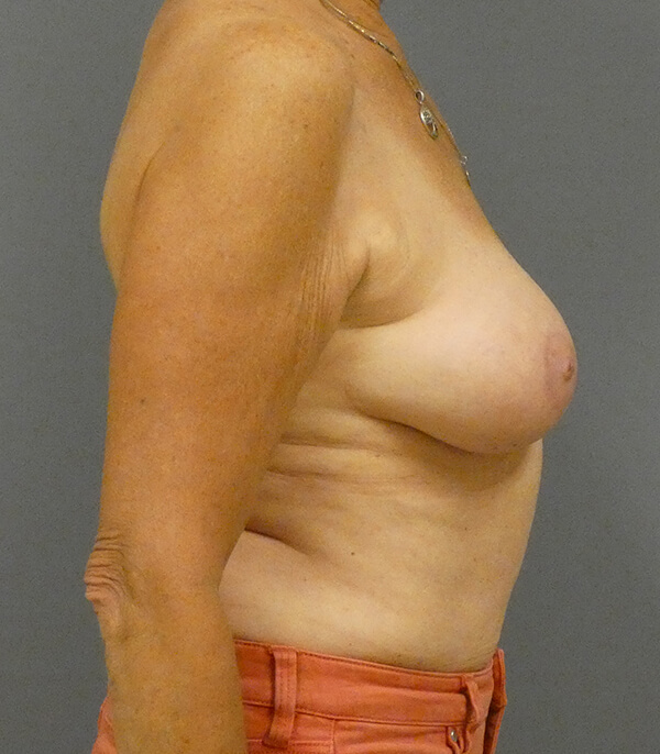 Breast Reduction Before Patient Thumbnail 3