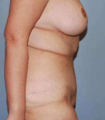 Body Contouring After Patient 1