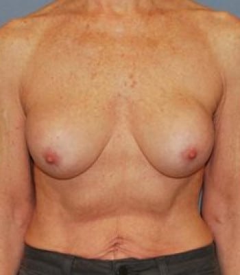 Breast Implant Revision Before Patient 1