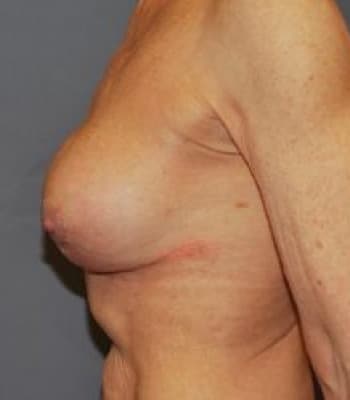 Breast Implant Revision After Patient Thumbnail 3