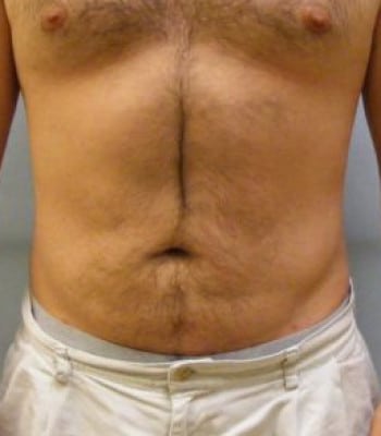 Liposuction for Men After Patient 1