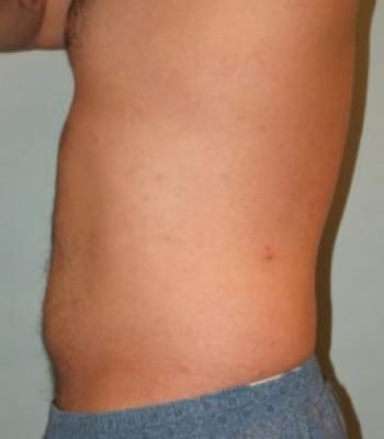 Liposuction for Men Before Patient 1