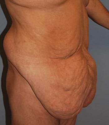 Body Contouring Before Patient 1