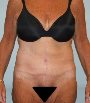 Body Contouring After Patient Thumbnail 1