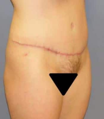 Tummy Tuck After Patient 1