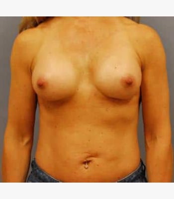 Breast Augmentation After Patient Thumbnail 1