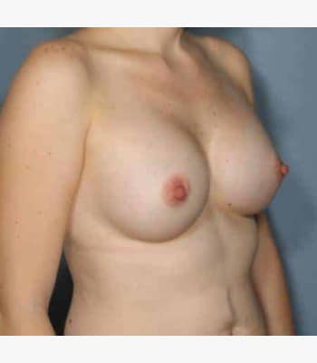 Breast Augmentation After Patient Thumbnail 2