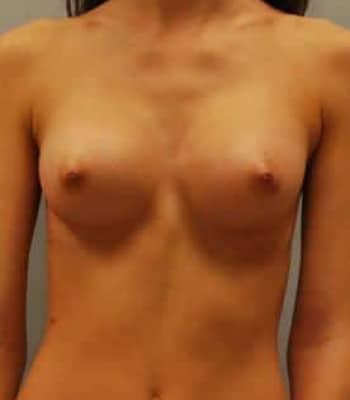 Breast Augmentation After Patient Thumbnail 1