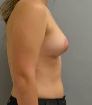 Breast Augmentation After Patient Thumbnail 3