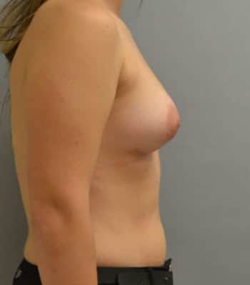 Breast Augmentation After Patient Thumbnail 5