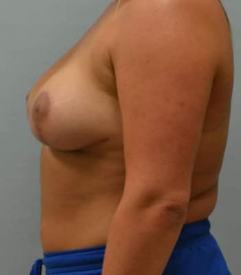 Breast Augmentation After Patient Thumbnail 2