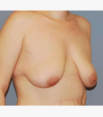 Breast Lift Before Patient Thumbnail 2