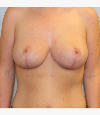 Breast Lift After Patient Thumbnail 1