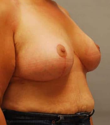 Breast Lift After Patient Thumbnail 3