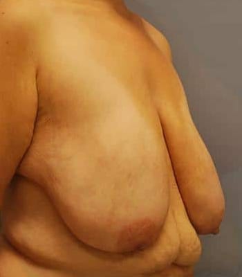 Breast Lift Before Patient Thumbnail 3