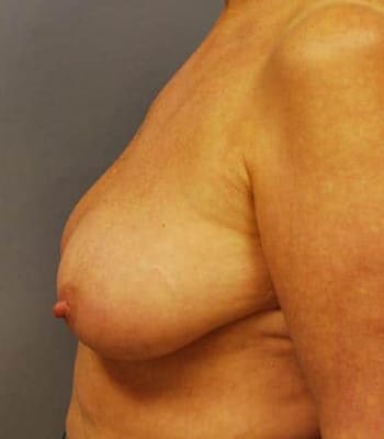 Breast Lift Before Patient Thumbnail 3