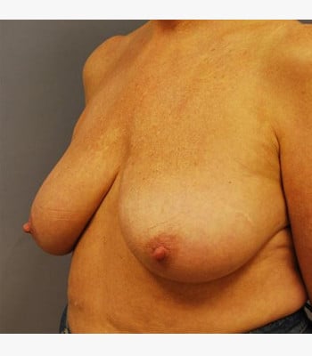Breast Lift Before Patient Thumbnail 2