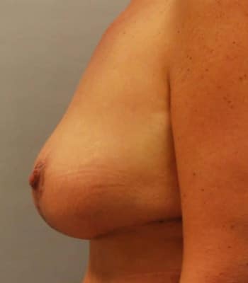Breast Lift After Patient Thumbnail 2