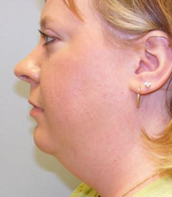 Liposuction for the Face Before Patient Thumbnail 2