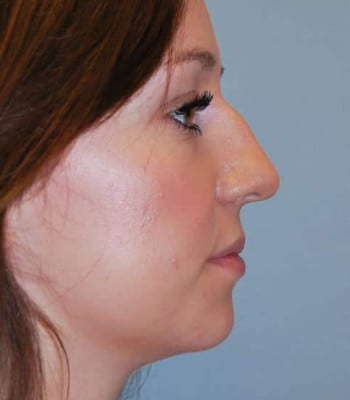 Rhinoplasty Before Patient Thumbnail 2