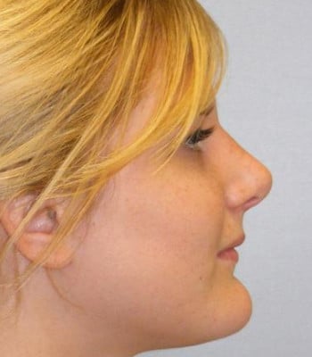 Rhinoplasty After Patient Thumbnail 2