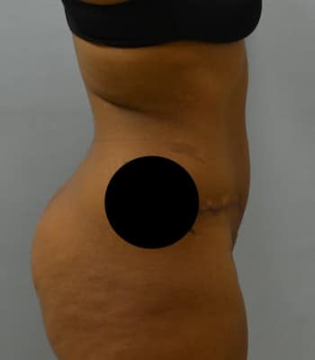 Tummy Tuck After Patient 1