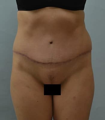Tummy Tuck After Patient Thumbnail 1