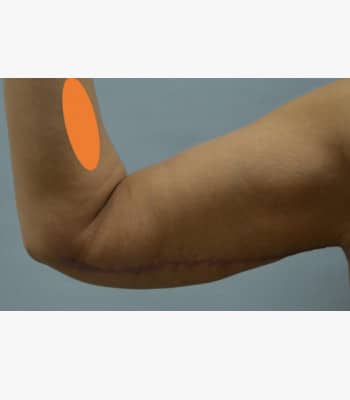 Arm Lift After Patient Thumbnail 2
