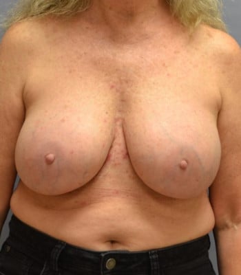 Breast Implant Revision After Patient Thumbnail 1