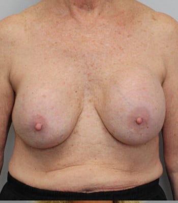 Breast Implant Revision Before Patient 1