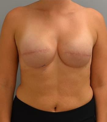 Breast Reconstruction After Patient Thumbnail 1