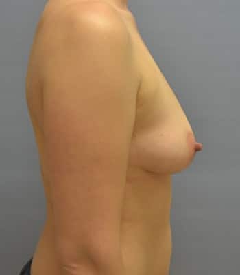 Breast Reconstruction Before Patient Thumbnail 3