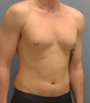 Male Breast Reduction Before Patient Thumbnail 2