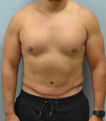 Tummy Tuck for Men After Patient 1